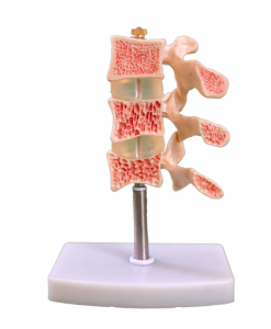 A typical lesion model of the spine