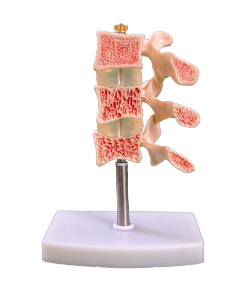 Model lesi tulang belakang yang khas