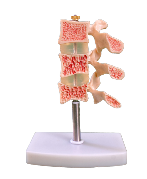 Iyo yakajairika lesion modhi yemuzongoza