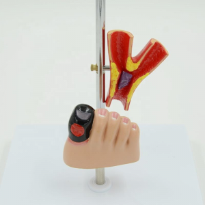 Medical Science Diabetic Foot Anatomical Model Show Patterns of Diabetes Including Pathological Organ Patterns