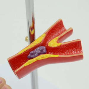 Medical Science Diabetic Foot Anatomical Model Show Patterns of Diabetes Including Pathological Organ Patterns