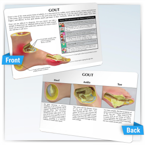 Тулайны хүндрэлийн эмгэг судлалын загвар Хөлний үе мөчний анагаах ухааны үе мөчний үрэвсэл Анагаахын сургуулийн хэрэглээнд зориулсан шагай хөлний үений загвар