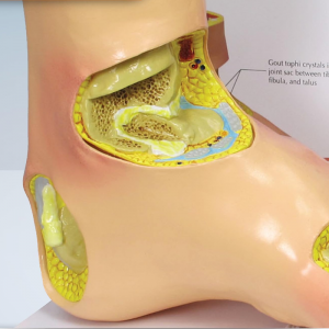 Тулайны хүндрэлийн эмгэг судлалын загвар Хөлний үе мөчний анагаах ухааны үе мөчний үрэвсэл Анагаахын сургуулийн хэрэглээнд зориулсан шагай хөлний үений загвар