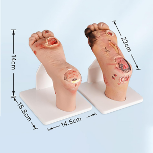 Teaching Aid Diabetic Foot Model (Mild/Severe) for Medical Training Education Preventive Diabetic Foot Manikin