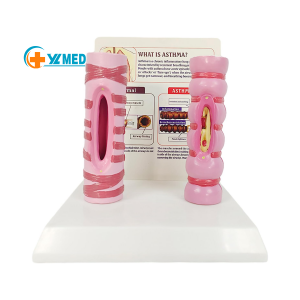 Medical Science Teaching Model PVC Normal VS Asthmatic Trachea Comparison Model for Respiratory Education