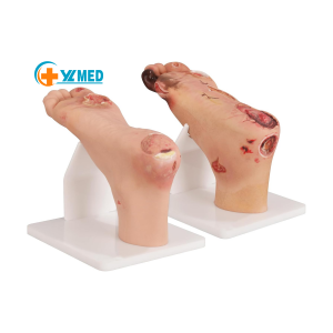 Teaching Aid Diabetic Foot Model (Mild/Severe) for Medical Training Education Preventive Diabetic Foot Manikin