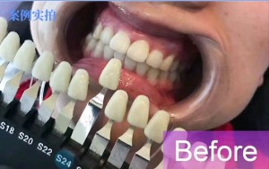 Cold Light Whitening Instrument LED Blue Card in de kolom klemtafel blekenlamp cosmetisch tandheelkundig schoonheidsinstrument