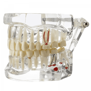 Ultrassist Transparent Disease Teeth with Dental Implant Bridge Dental Model