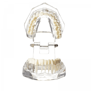 Ultrassist Transparent Disease Teeth yokhala ndi Dental Implant Bridge Dental Model