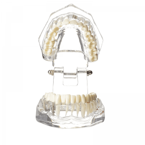 Ultrassist transparente enfermedad dientes con implante dental puente modelo dental