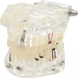 Ultrassist Transparent Disease Cov hniav nrog Dental Implant Choj Dental Model