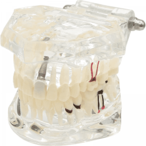 Ultrassist Transparent Disease Teeth with Dental Implant Bridge គំរូធ្មេញ