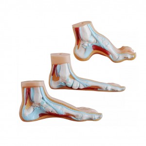 Medical science teaching demonstration anatomy human pathological foot anatomy Flatfoot high arched foot model