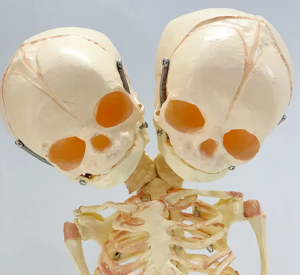 Modello dimostrativo didattico del modello di scheletro fetale a doppia testa deformata