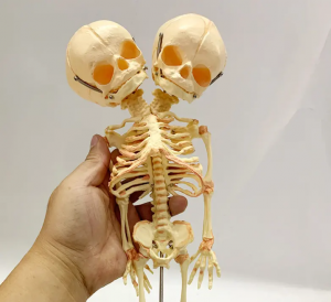 Teaching demonstration model of deformed double head fetal skeleton model