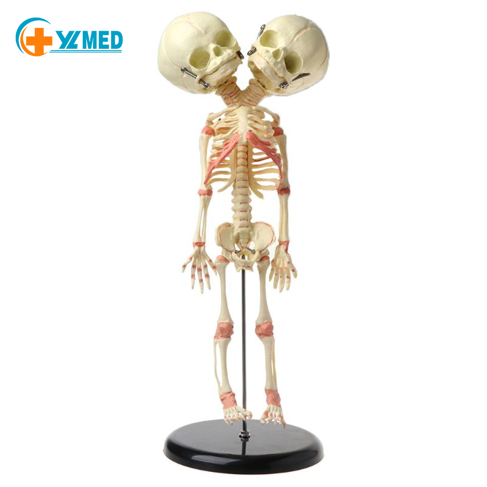 Instrua pruvmodelo de misformita duobla kapo feta skeletmodelo