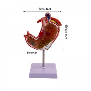 Clinic Display Medical School Anatomical Model Human Gastric Lesion Model Anatomy Pathological Stomach Model