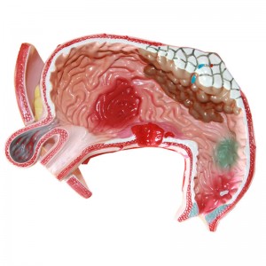Clinic Display Medical School Anatomical Model Human Gastric Lesion Model Anatomy Pathological Stomach Model