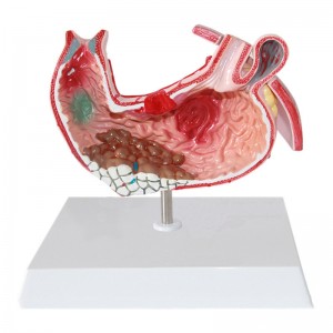 Clinic Display Medical School Anatomical Model Human Gastric Lesion Model Anatomy Pathological Stomach Model
