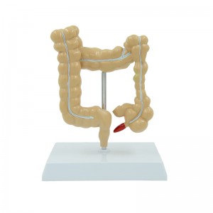 Medical College Gastroenterology Display Model Human Colonic Disease Model Large Intestine Pathological Model