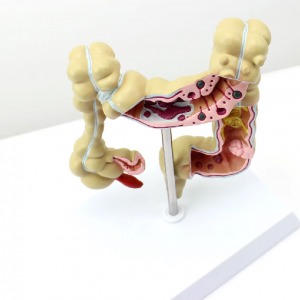 Medical College Gastroenterology Display Model Human Colonic Disease Model Large Intestine Pathological Model