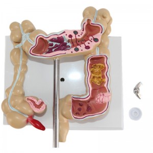 Medical College Gastroenterology Display Model Human Colonic Disease Model Large Intestine Pathological Model