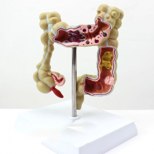 Medical College Gastroenterology Display Model Human Colonic Disease Model Large Intestine Pathological Model