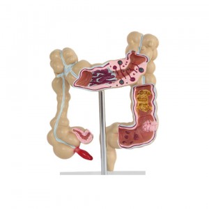 Medical College Gastroenterology Display Model Human Colonic Disease Model Large Intestine Pathological Model