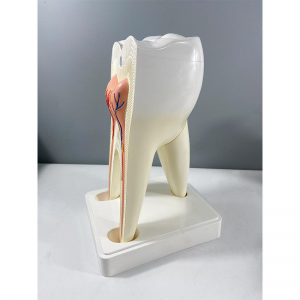 Enlarged Model Display Human Anatomy Model Biology Teaching Medical Science 2 Parts Molar Tooth Decay Molar Model