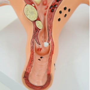 The medical school teaches the human model of pathological changes of female reproductive uterus and ovary
