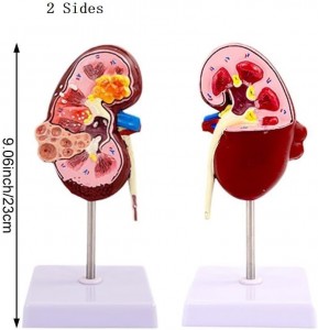 Medical Science Human Urinary System Disease Model for Teaching Use Class Tools Pathology Kidney Anatomy Model