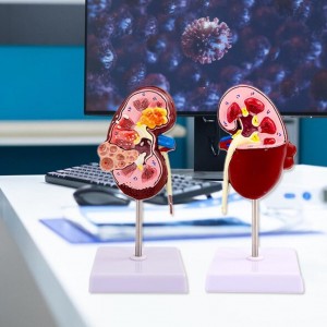 Medical Science Human Urinary System Disease Model for Teaching Use Class Tools Pathology Kidney Anatomy Model