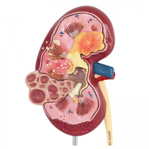 Medical Science Human Urinary System Disease Model for Teaching Use Class Tools Pathology Kidney Anatomy Model