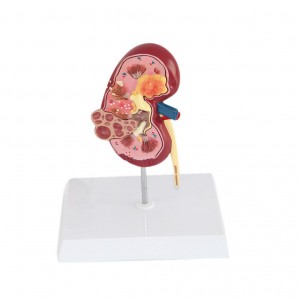 Medical Science Human Urinary System Disease Model for Teaching Use Class Tools Pathology Kidney Anatomy Model