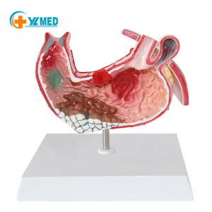 Medical research stomach anatomical model pathological stomach and stomach disease model