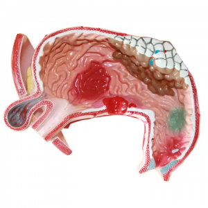 Medical research stomach anatomical model pathological stomach and stomach disease model