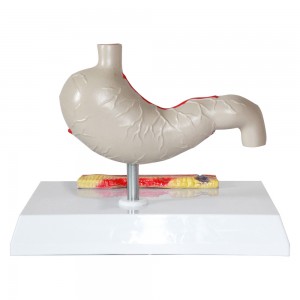 Clinic Display Medical School Anatomical Model Human Gastric Lesion Model Anatomy Pathological Stomach Model
