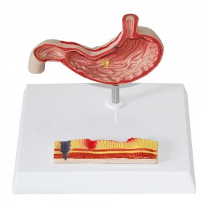 Clinic Display Medical School Anatomical Model Human Gastric Lesion Model Anatomy Pathological Stomach Model