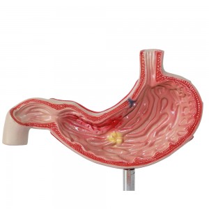 Clinic Display Medical School Anatomical Model Human Gastric Lesion Model Anatomy Pathological Stomach Model