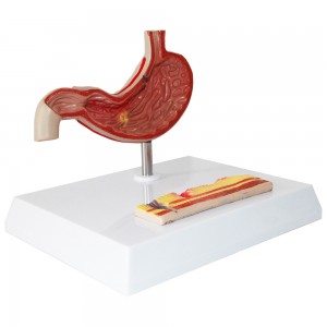 Clinic Display Medical School Anatomical Model Human Gastric Lesion Model Anatomy Pathological Stomach Model
