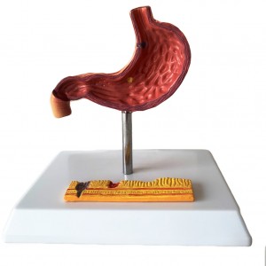 Clinic Display Medical School Anatomical Model Human Gastric Lesion Model Anatomy Pathological Stomach Model
