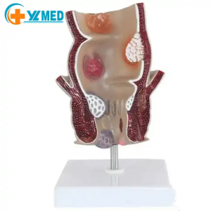 Pangajaran médis Dipaké pikeun ngajarkeun tampilan enlarged of anorectal jarawat model patologis rectal model anatomis peujit