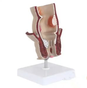 Medical teaching Used for teaching enlarged display of anorectal acne pathological model rectal intestinal anatomical model