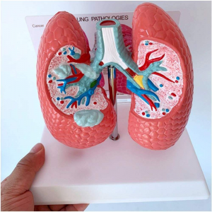 Medical Science Human Healthy Lung Compared with Sick Lung Contrast Model Internal Organ Dissection Demonstration Teaching