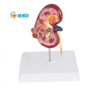 Anatomy urology special renal lesion model human kidney anatomy model