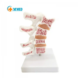 Meditsiiniõppe skeletimudel Elusuuruses Inimese anatoomilise osteoporoosi täiustatud mudel