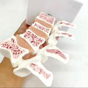 Medisinsk opplæring Skjelettmodell Avansert menneskelig anatomisk osteoporosemodell i naturlig størrelse