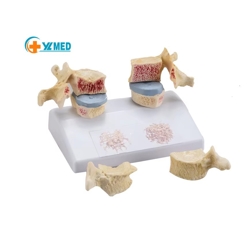 Human Skeleton Osteoporosis Pathological Model Medical Science PVC Material YULIN Brand YL2-10048