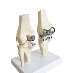 2025 New Detachable Artificial Small Double Silver Knee Joint Implant Model Set Manikin for Knee Prosthesis