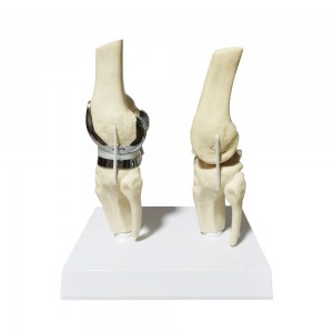 2025 New Detachable Artificial Small Double Silver Knee Joint Implant Model Set Manikin for Knee Prosthesis